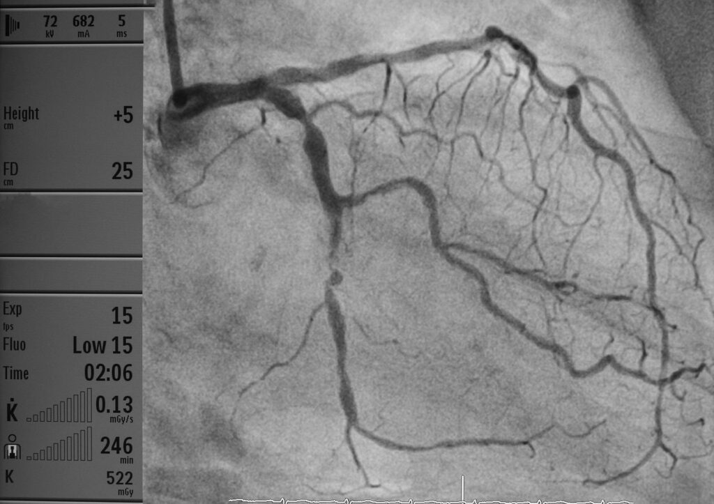 Coronary artery angiography for coronary artery disease