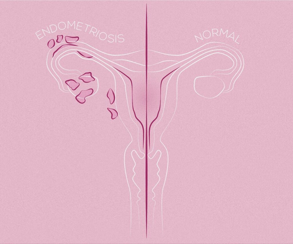 Pink outlined diagram of a uterus with and without endometriosis.